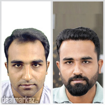 Best FUE hair transplant in Karachi - HASH CLINICS