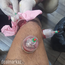 Best Hijama Cupping Centre in Karachi
